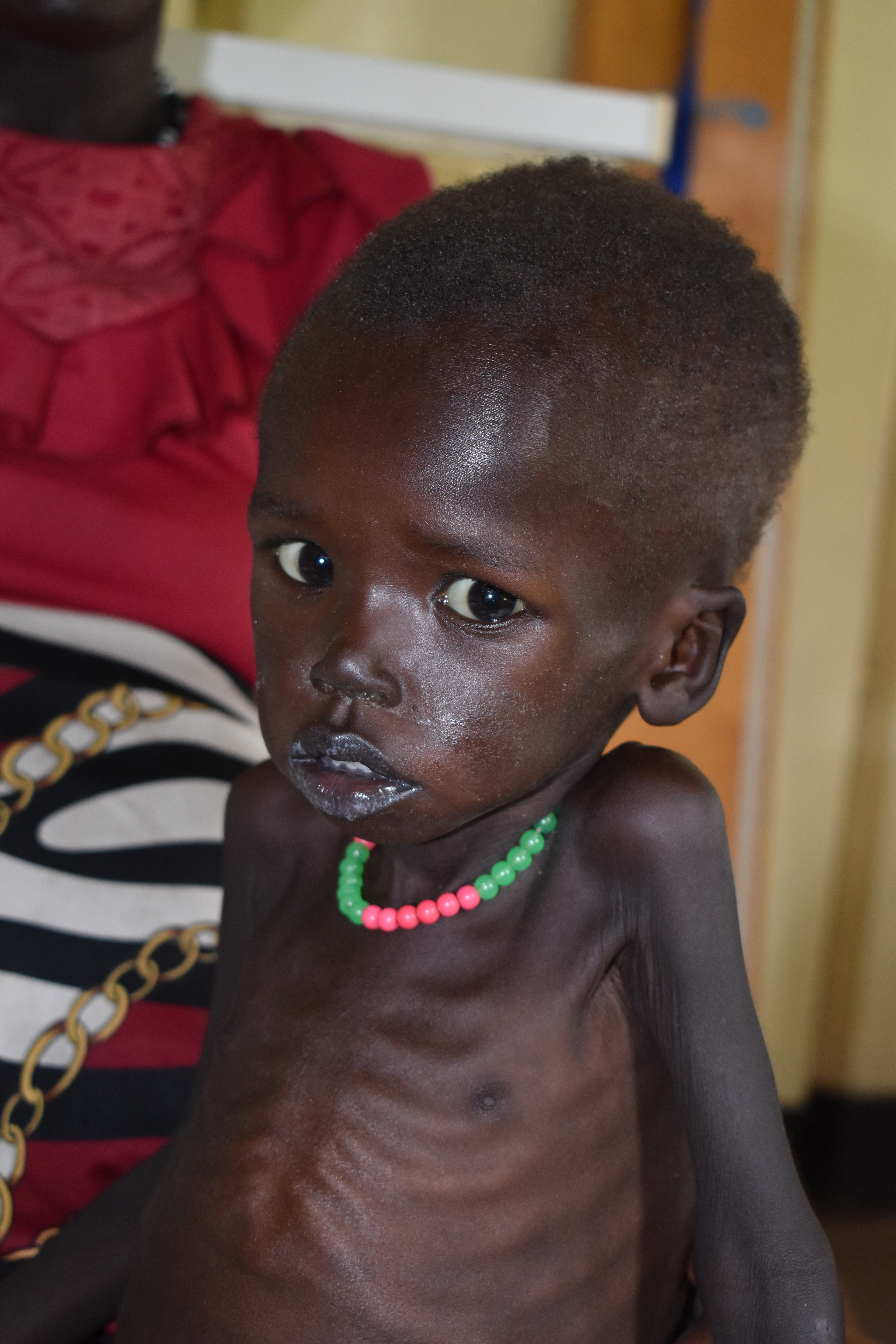 Makol Mading ist mit seinen Kräften am Ende. Der Zweijährige leidet neben Malaria und Durchfall an einer lebensbedrohlichen Mangelernährung. Makol Mading ist mit seinen Kräften am Ende. Der Zweijährige leidet neben Malaria und Durchfall an einer lebensbedrohlichen Mangelernährung.