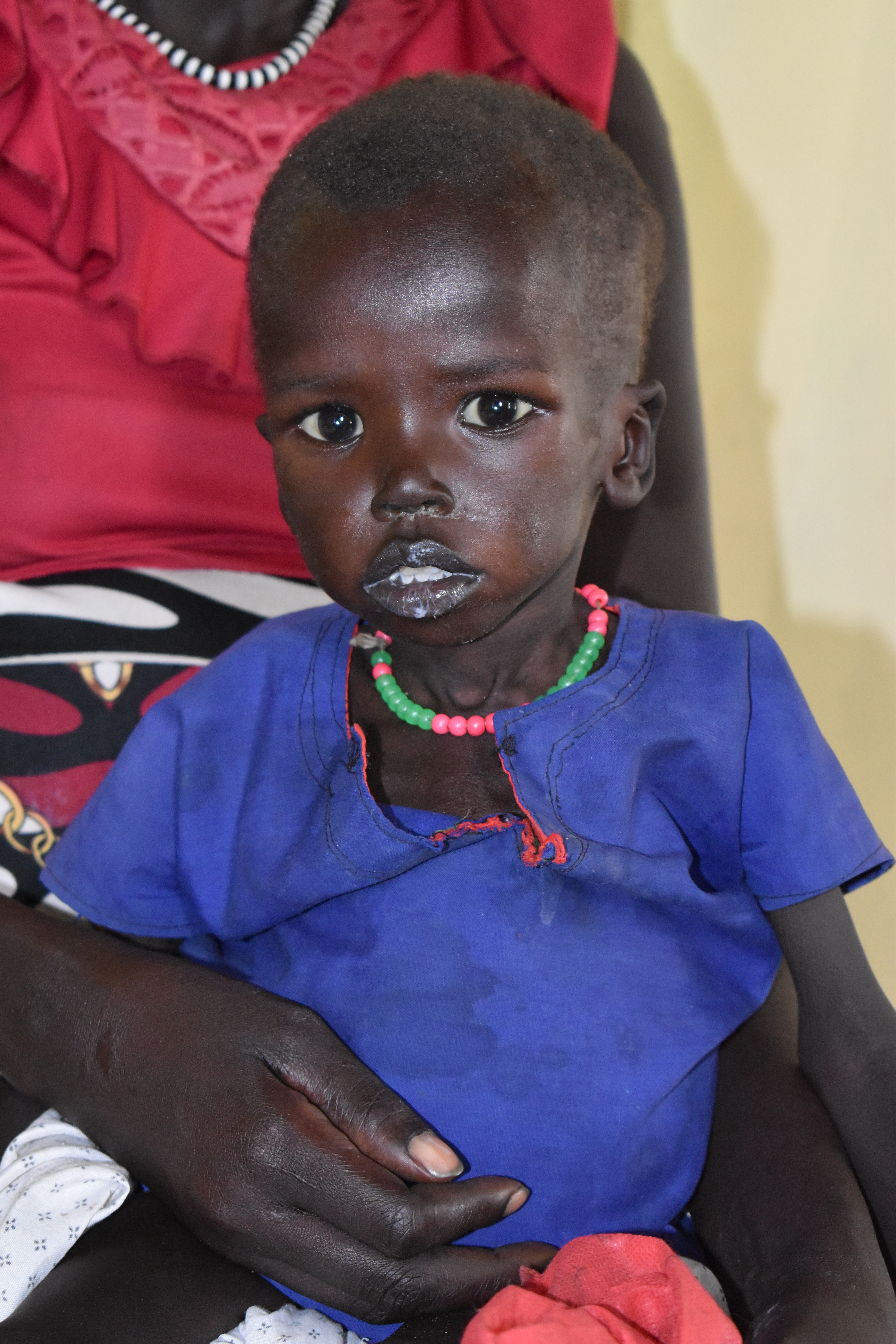 Vor Makol liegt ein schwerer Weg, bis er wieder gesund ist. Mit Ihrer Spende leisten Sie einen segensreichen Beitrag für das Wohl der Kinder im Südsudan! Vor Makol liegt ein schwerer Weg, bis er wieder gesund ist. Mit Ihrer Spende leisten Sie einen segensreichen Beitrag für das Wohl der Kinder im Südsudan!