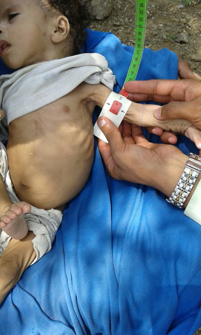 Durch verunreinigtes Wasser und schlechte hygienische Verhältnisse sind viele Jemeniten an der tödlichen Cholera erkrankt. Mangelernährte Kinder sind besonders gefährdet.