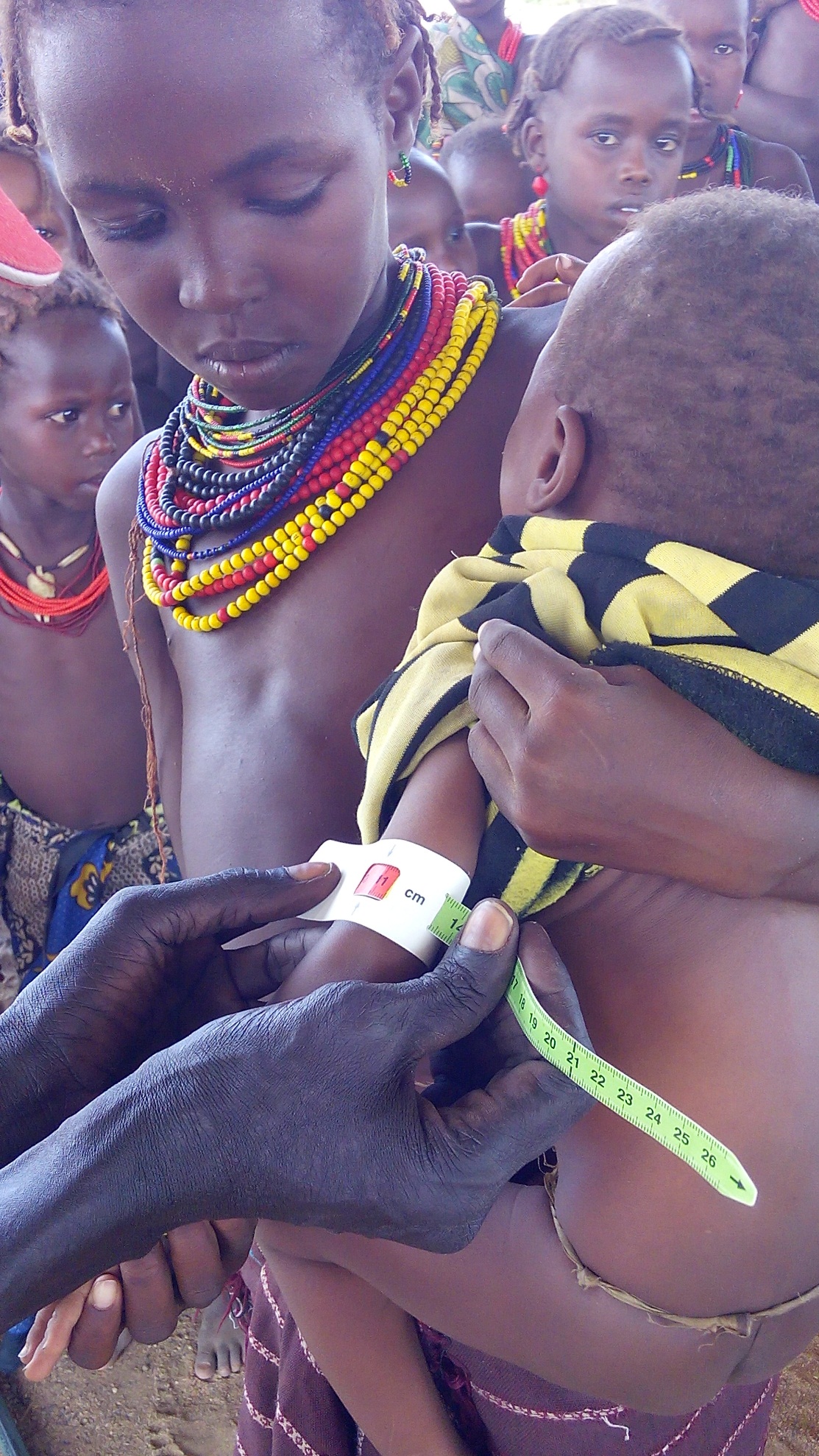 Ein Hoffnungszeichen-Mitarbeiter misst den Grad der Unterernährung bei einem Kleinkind. Sechs von zehn Kindern in Kenia sind akut unterernährt. Ein Hoffnungszeichen-Mitarbeiter misst den Grad der Unterernährung bei einem Kleinkind. Sechs von zehn Kindern in Kenia sind akut unterernährt.