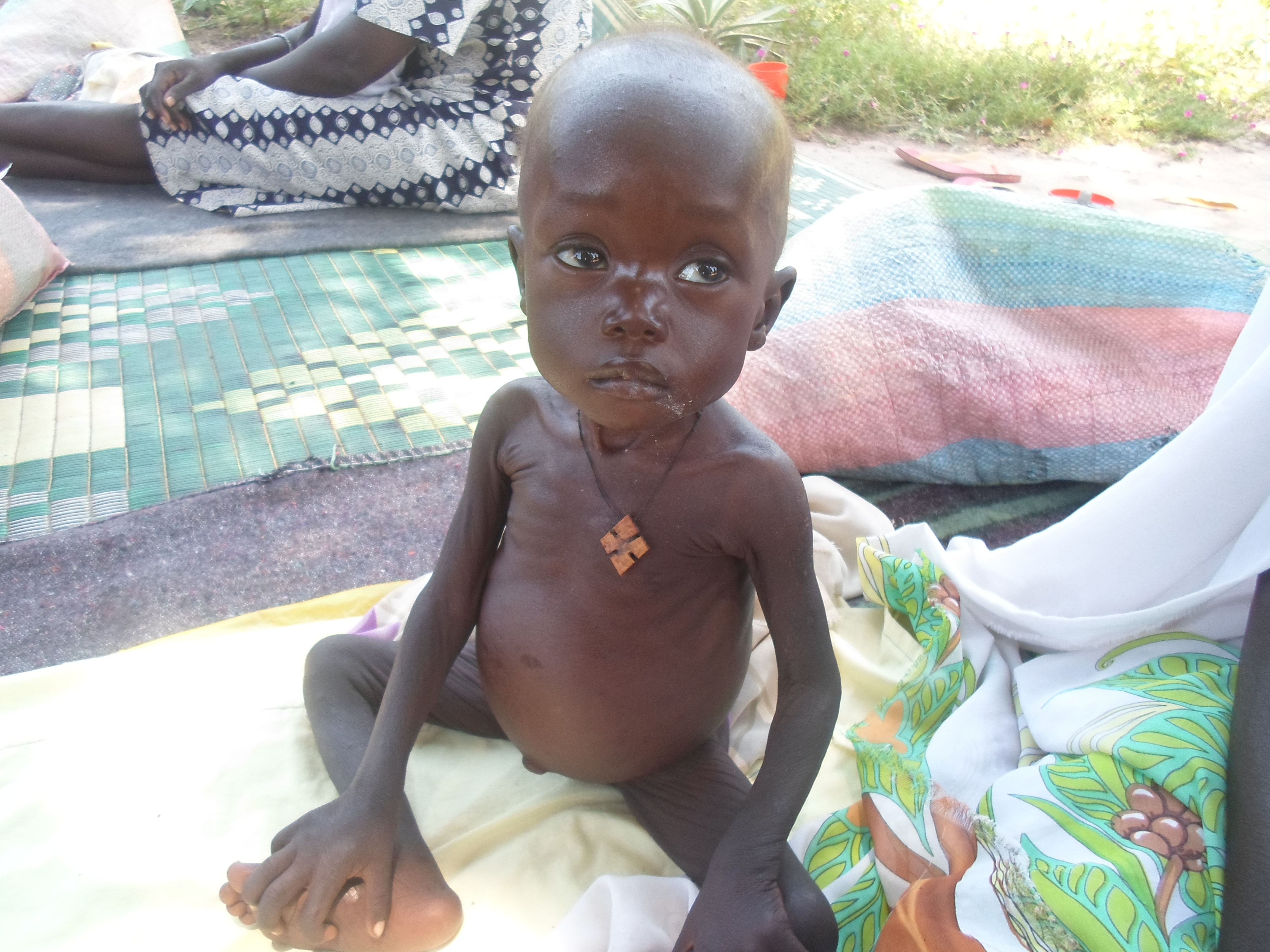 Akolde Mading ist zwei Jahre alt und schwer mangelernährt. Ihre Familie leidet sehr unter den Konflikten im Südsudan. Eine geregelte Feld- und Viehwirtschaft war ihnen unmöglich.