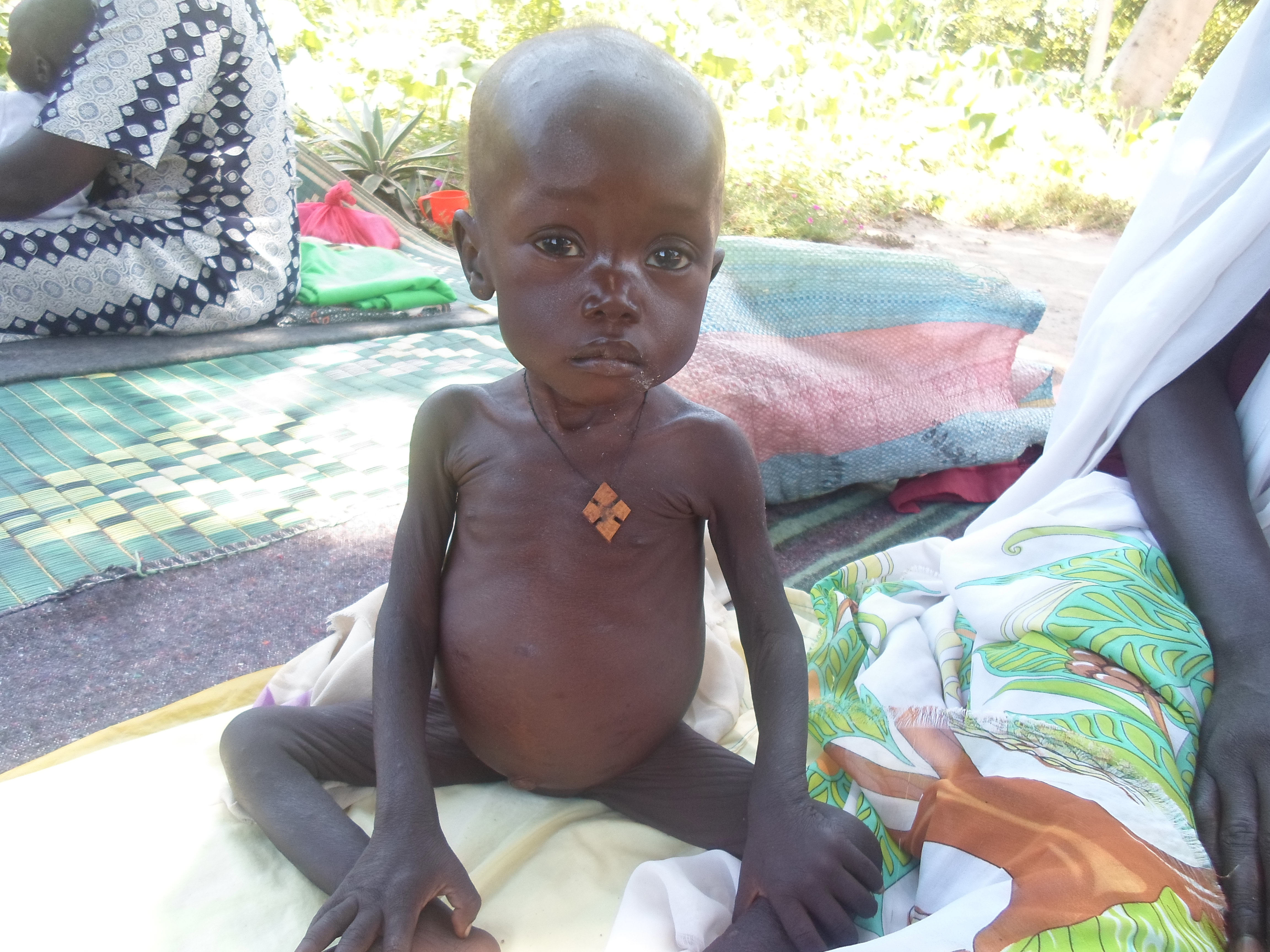 Akolde leidet neben Mangelernährung auch an Malaria. Das Mädchen benötigt nun eine spezielle Ernährung und passende Medikamente. Mit Ihrer Unterstützung können Kinder wie Akolde behandelt werden.