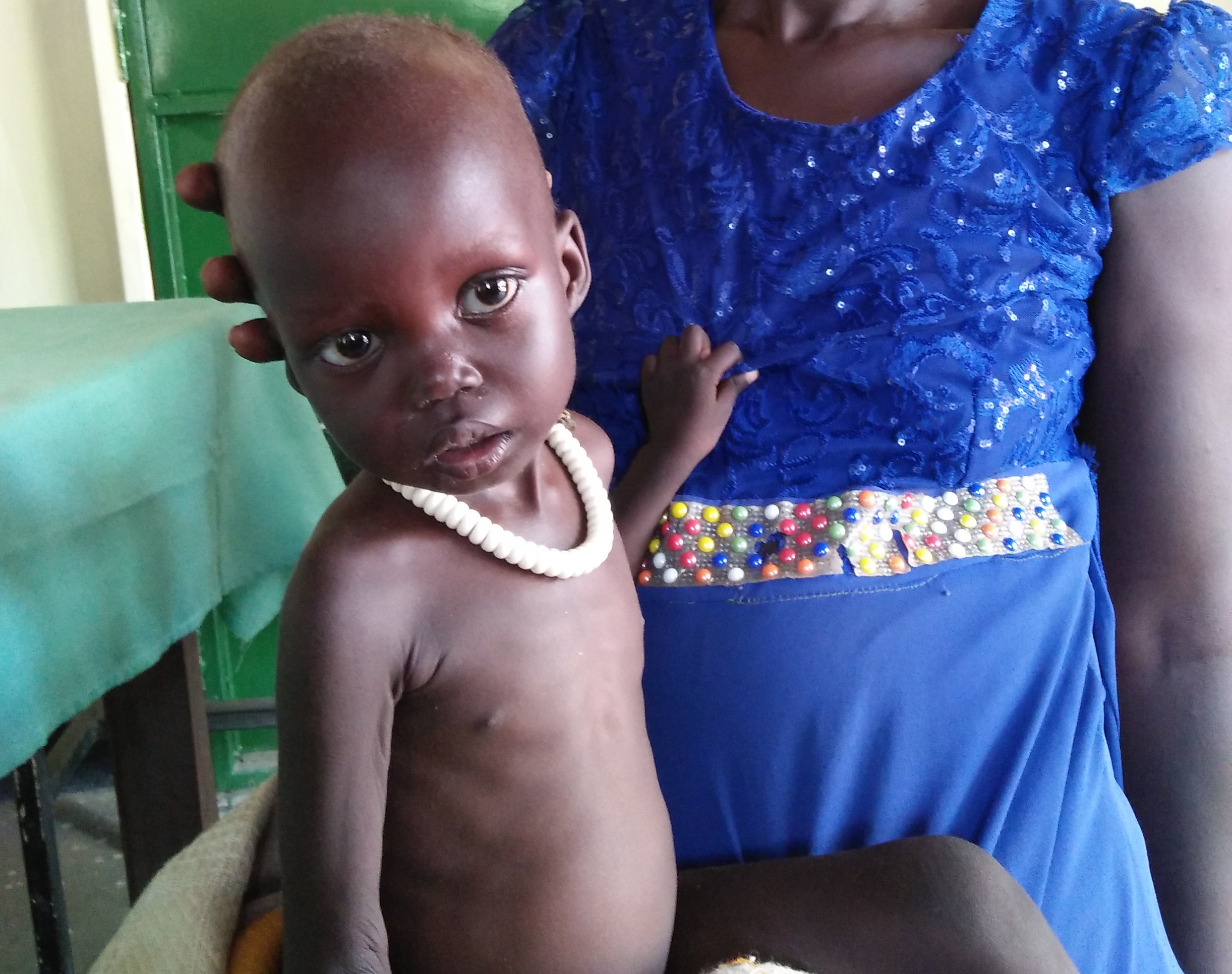 Die zweijährige Alek Maker ist schwer unterernährt, als ihre Mutter sie in die Klinik der Diözese Rumbek bringt. Die Covid-19-Pandemie macht Lebensmittel für viele Familien noch unerschwinglicher.