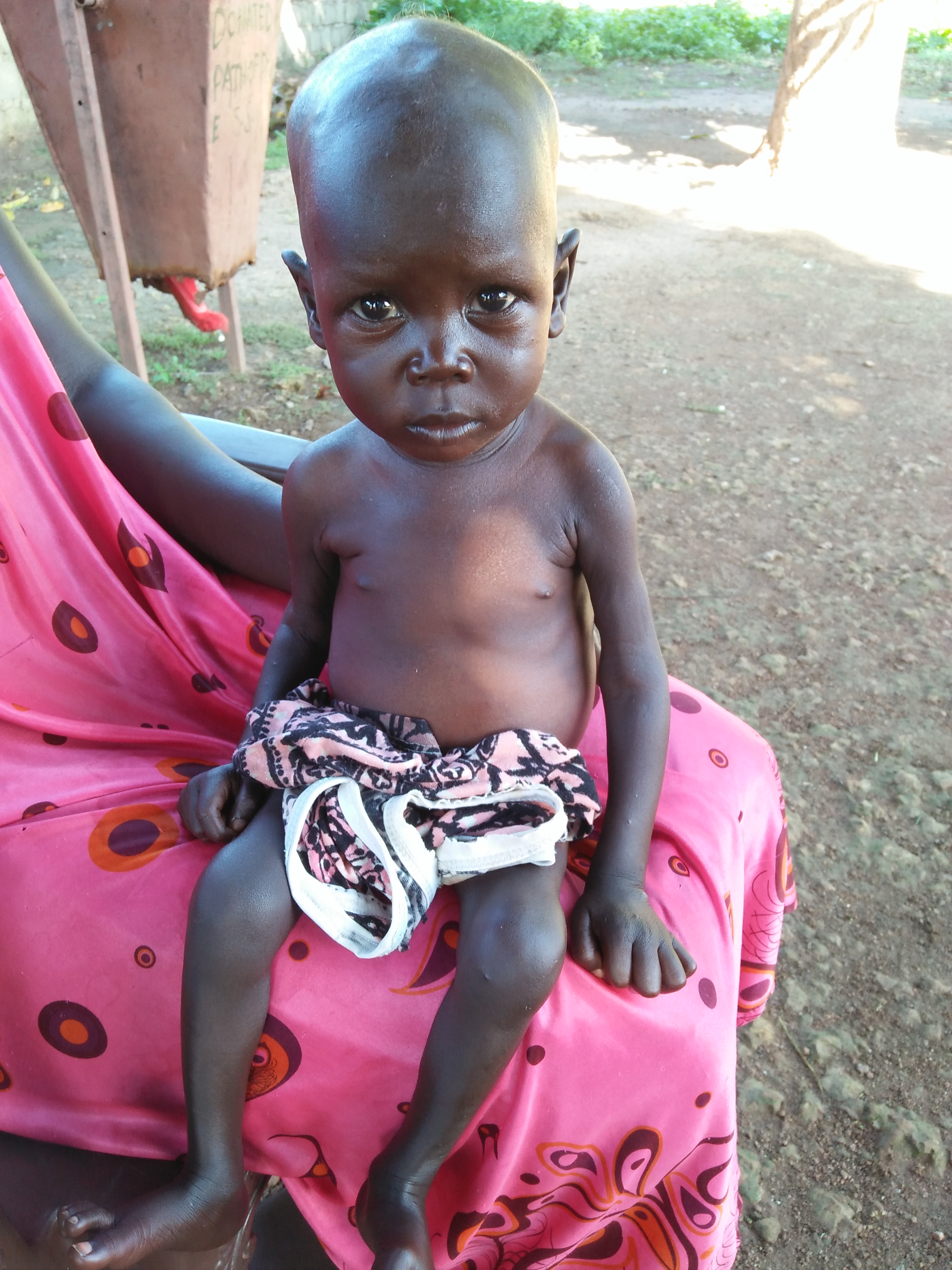 Das 18 Monate alte Mädchen braucht neben Medikamenten gegen ihre Malaria-Infektion dringend Spezialnahrung. Mit Ihrer Unterstützung kann Kindern wie Saba geholfen werden!