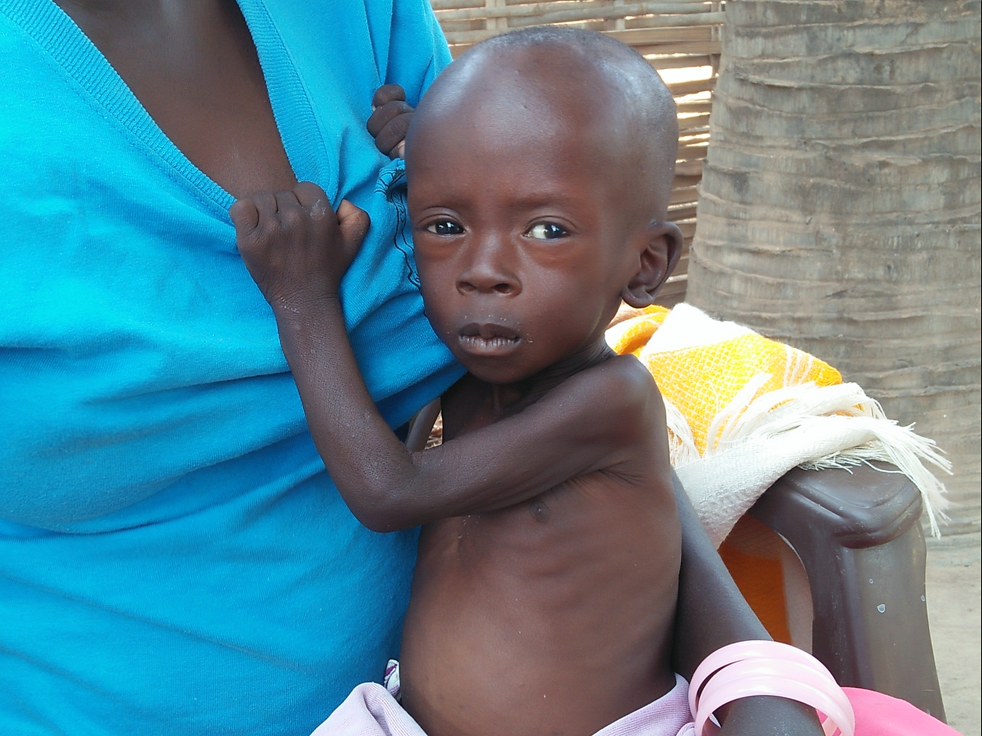 Das Ausmaß seiner Mangelernährung zeigt sich an seinem aufgeblähten Bauch, dem zu geringen Körpergewicht und der faltigen, schlaffen Haut.