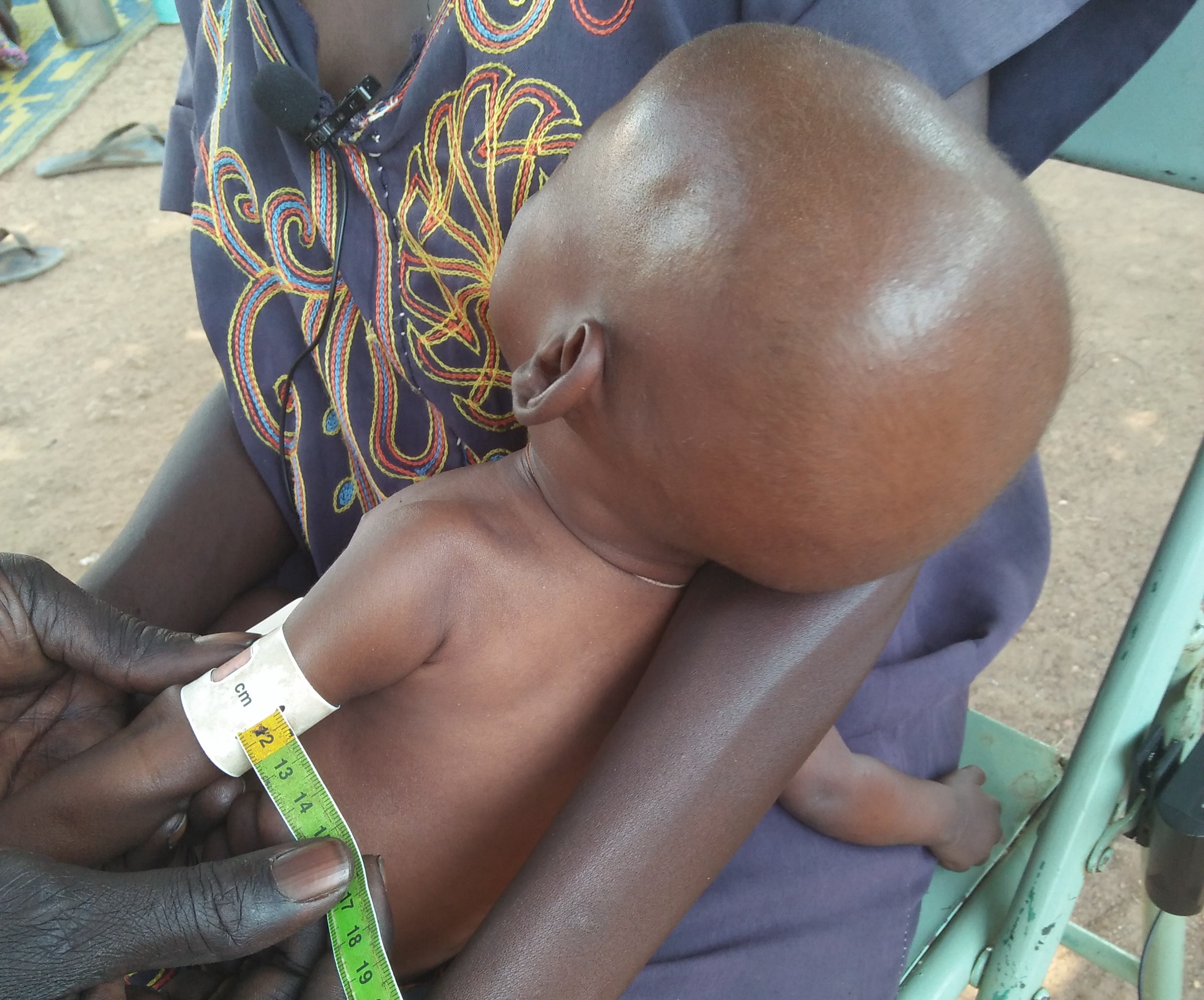 Das MUAC-Band, das am Oberarm eines Kleinkindes angelegt wird, zeigt einen Wert im roten Bereich – Akol ist extrem mangelernährt und in großer Gefahr.