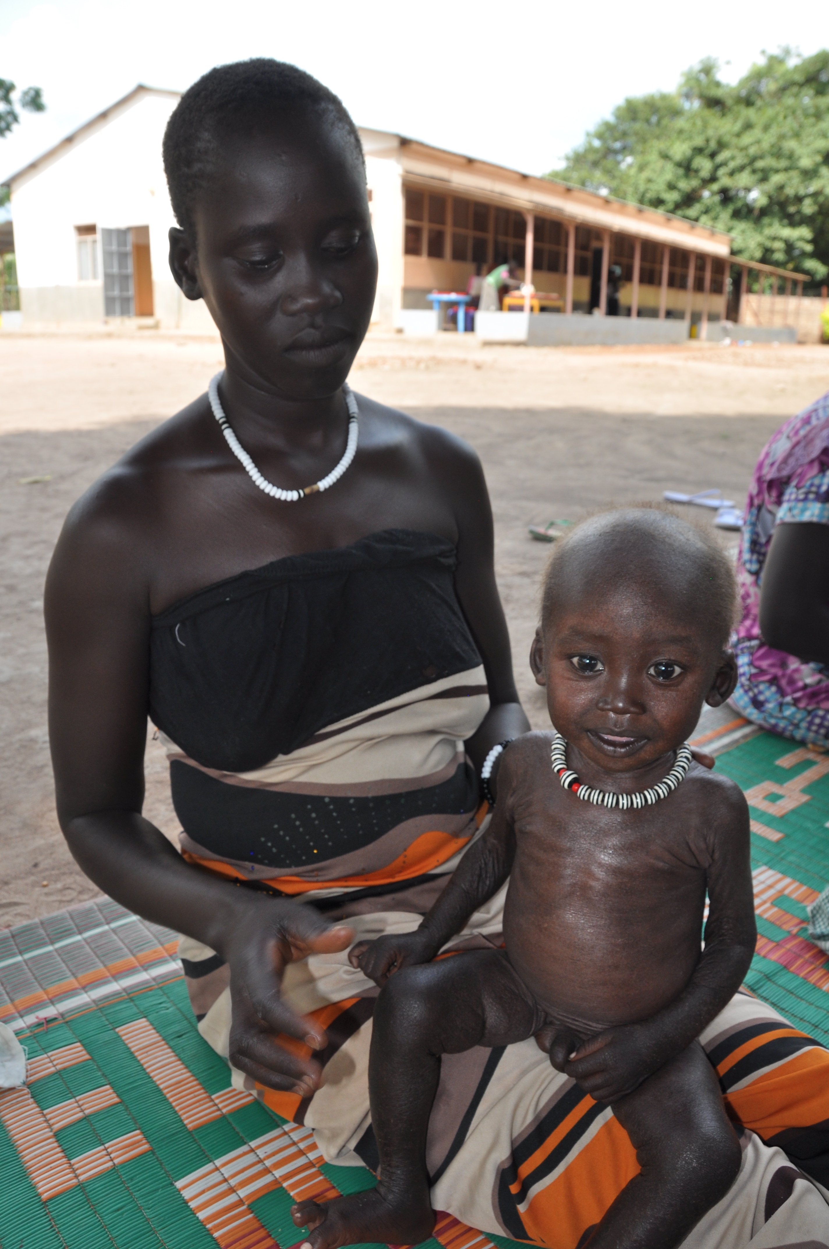 Als Meen von seiner Mutter in unsere Gesundheitsstation in Rumbek gebracht wird, ist er schwer mangelernährt.