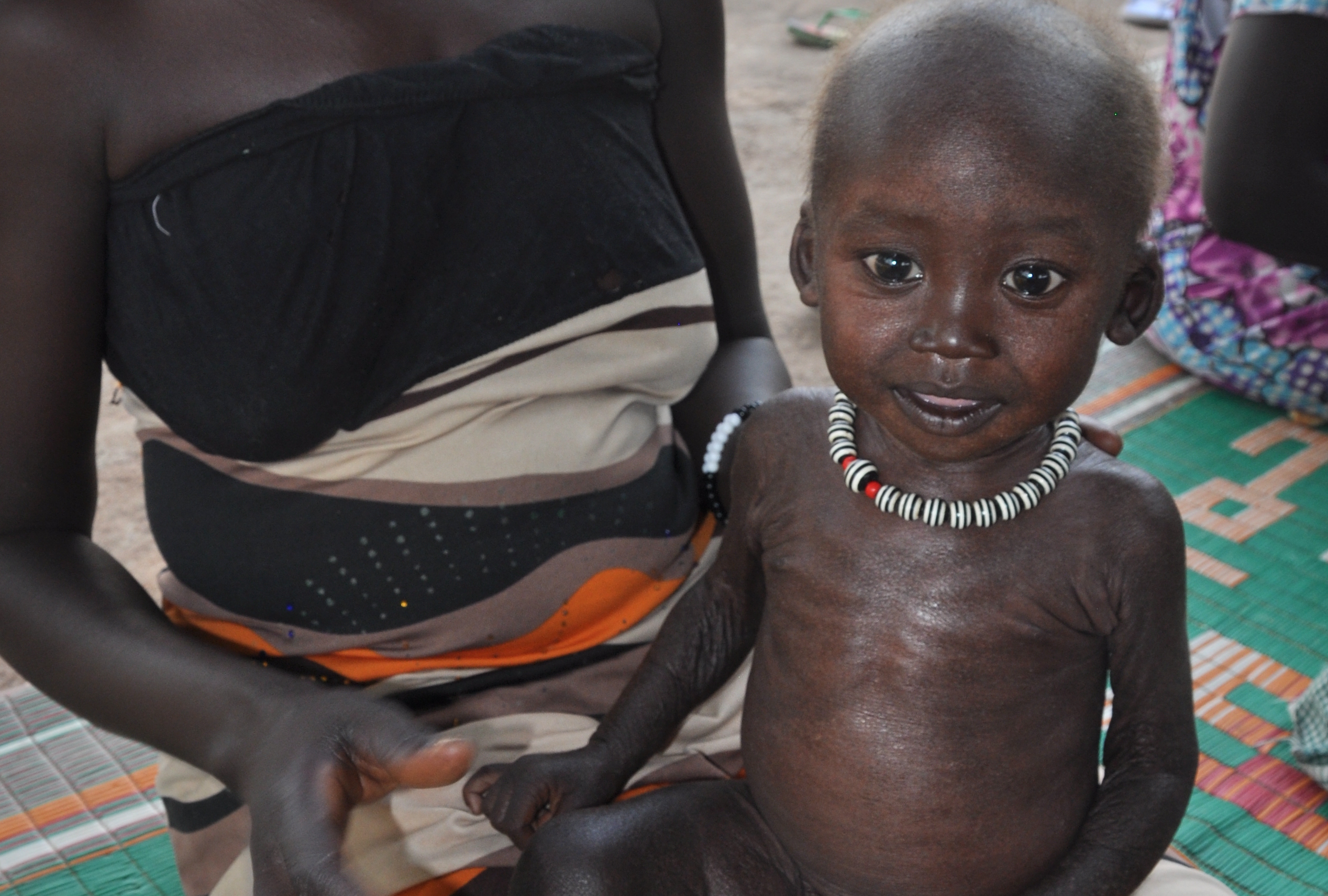 Seine Mutter brachte Meen schwer mangelernährt und mit einem schlimmen Ausschlag in unsere Klinik. Wir berichteten über ihn im November. Seine Mutter brachte Meen schwer mangelernährt und mit einem schlimmen Ausschlag in unsere Klinik. Wir berichteten über ihn im November.
