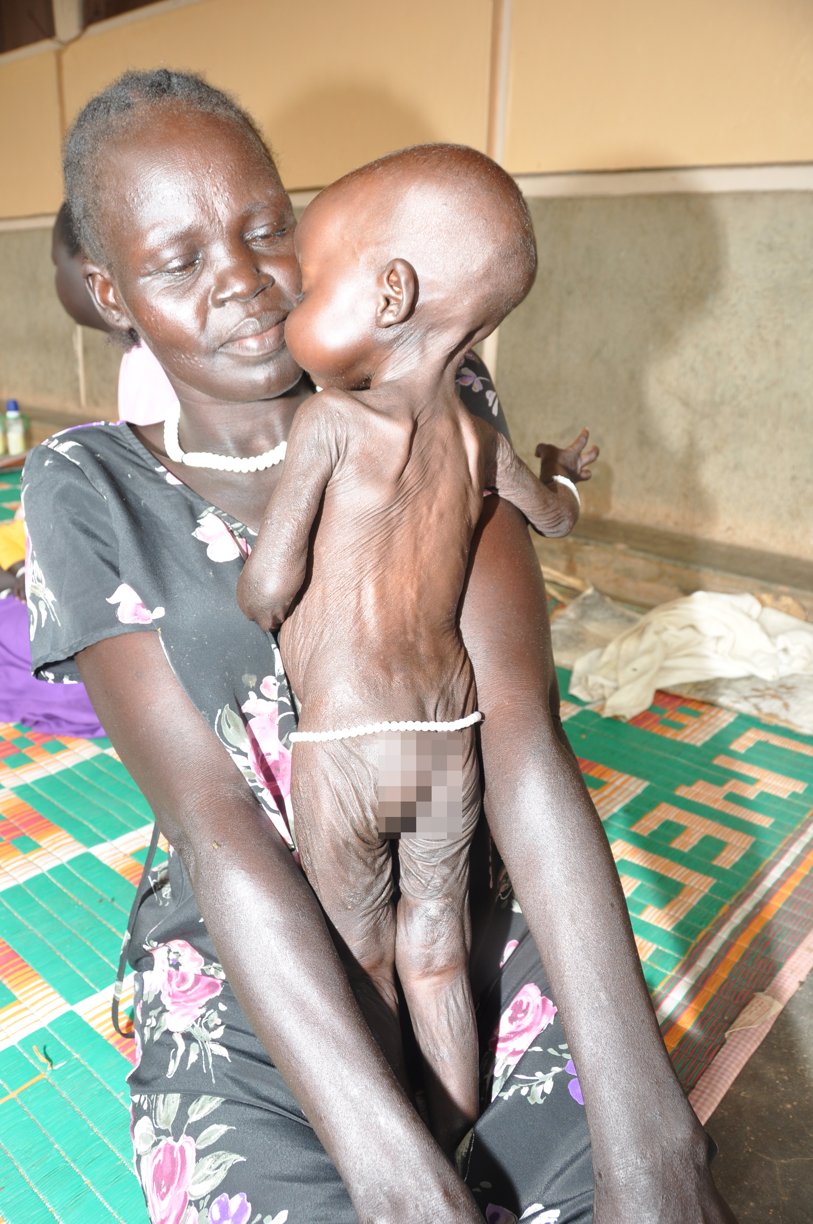 Ihre Haut ist schlaff und faltig, aber mit der richtigen Behandlung kann das Mädchen gesund werden. Dafür brauchen wir Ihre Hilfe – danke für jede Gabe!