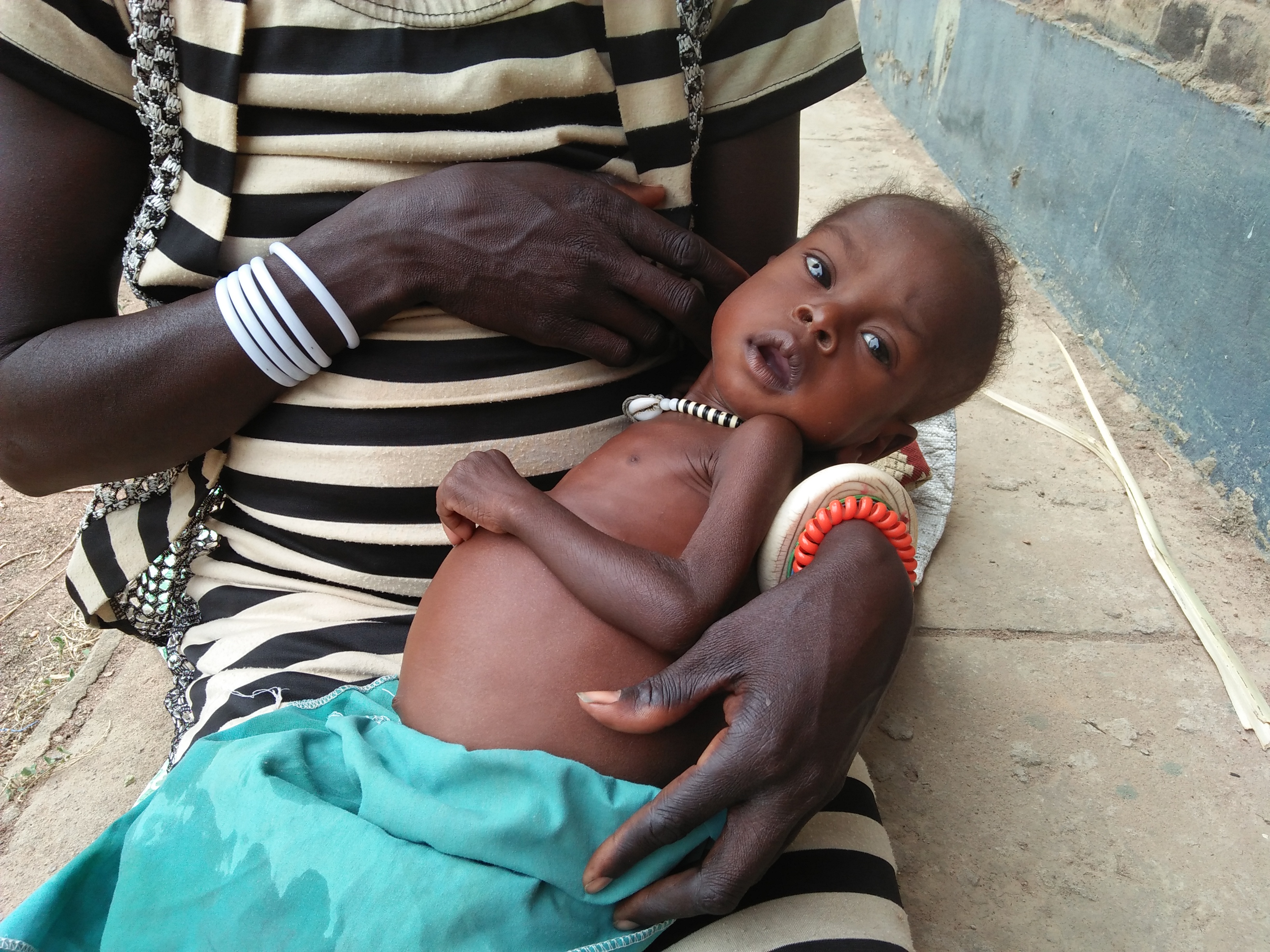 An dem aufgeblähten Bauch ist die Mangelernährung des Einjährigen deutlich zu erkennen; der übrige Körper ist viel zu dünn.