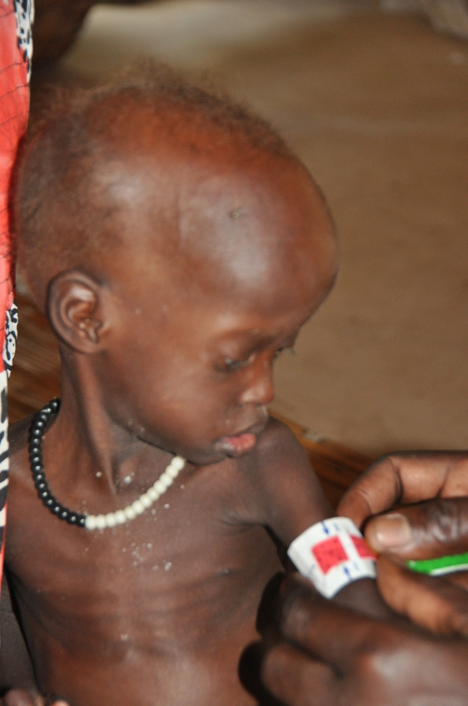 Die zweijährige Nyabuor ist schwer mangelernährt: Das MUAC-Band zeigt beim Messen des Oberarmumfangs den Wert von 9,2 cm im roten Bereich an.