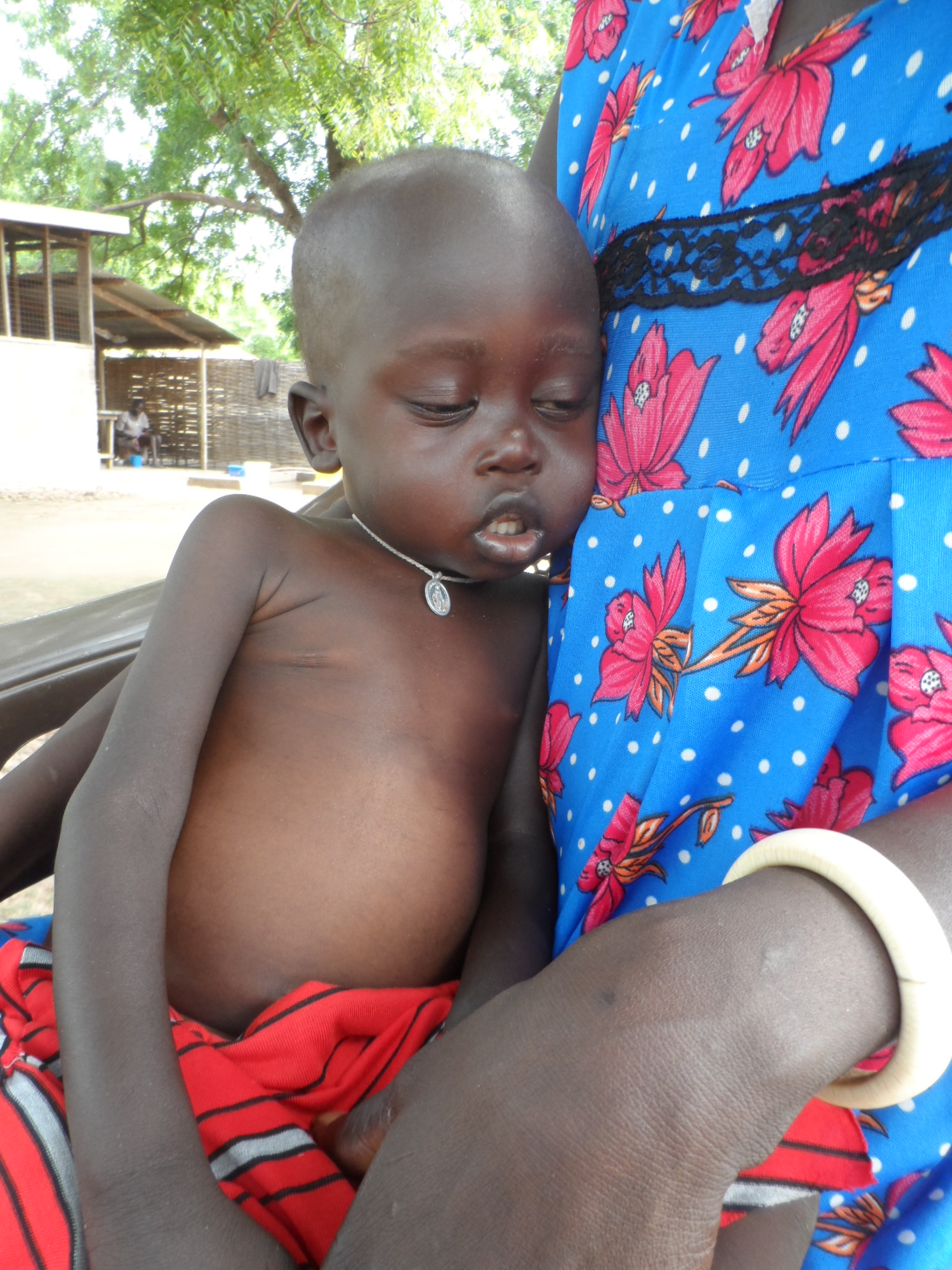 Bei seiner Einlieferung in die Krankenstation in Rumbek ist Bol so schwach, dass er nicht alleine sitzen und kaum seine Augen öffnen kann. Der Bauch des Kindes ist aufgebläht.