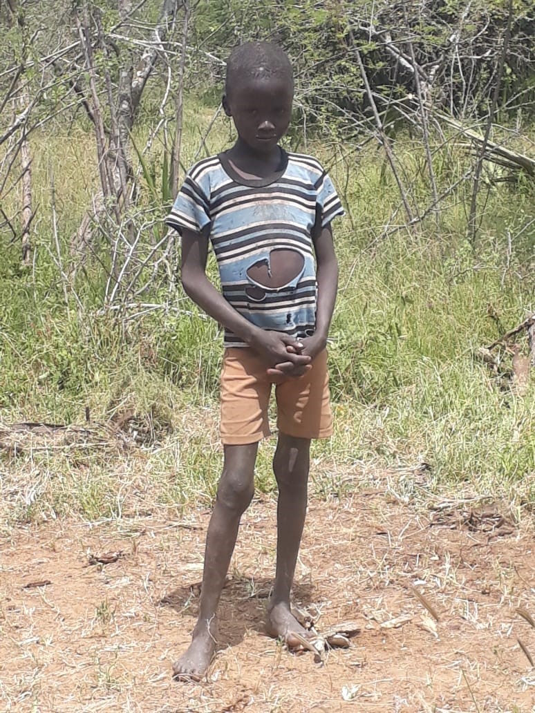 Der aufgedunsene Bauch, verursacht von Wassereinlagerungen und einer vergrößerten Leber, ist meist ein Anzeichen für Mangelernährung.