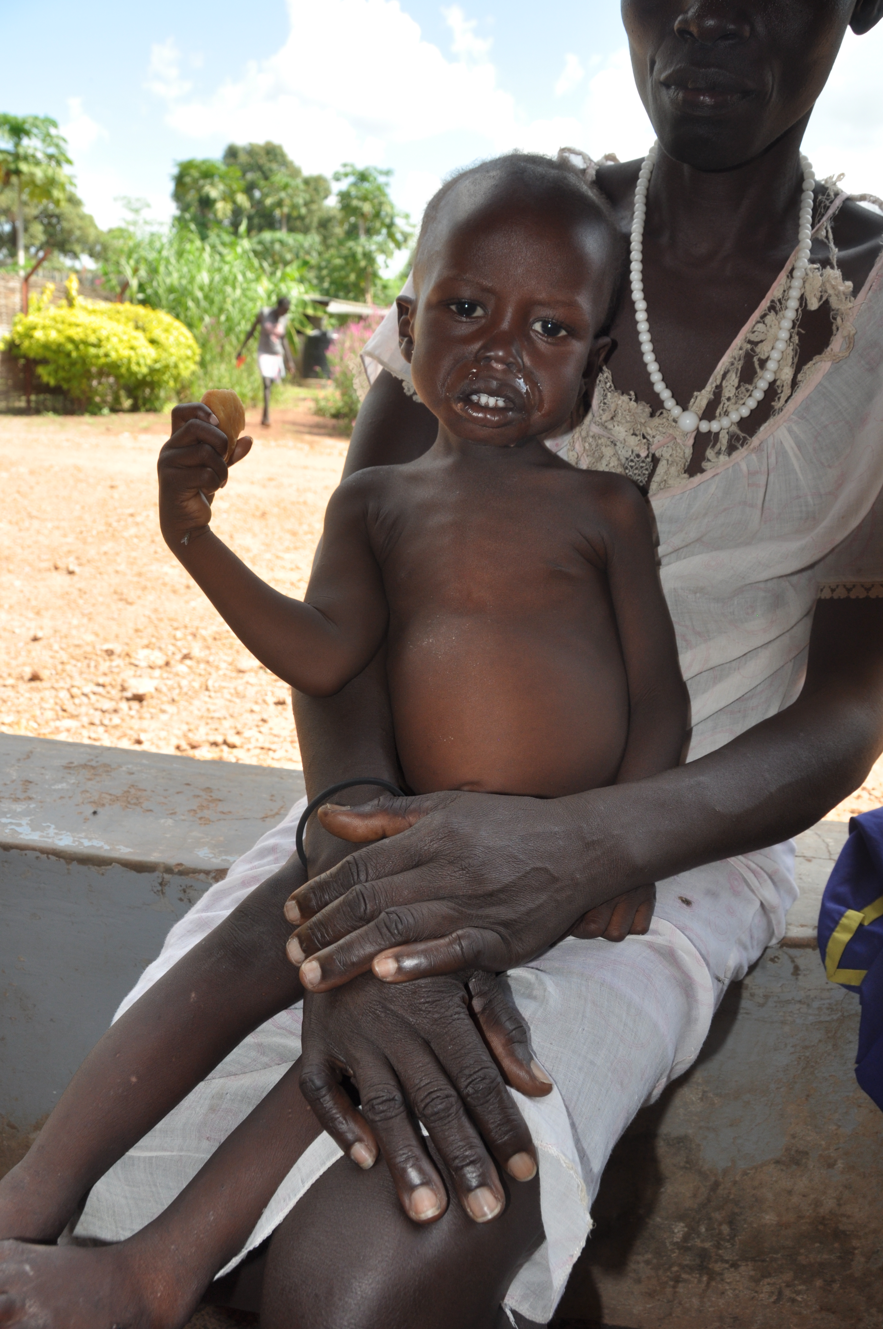 Die Mediziner haben Malongs Zustand stabilisiert. Doch der Junge muss noch weitere Wochen aufgepäppelt werden. Viele Kinder im Südsudan erleiden solch ein Schicksal – gemeinsam können wir ihnen helfen.