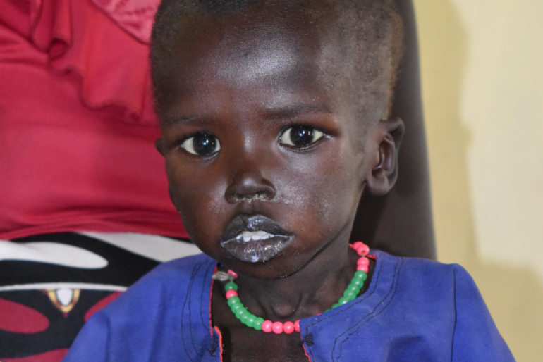 Vor Makol liegt ein schwerer Weg, bis er wieder gesund ist. Mit Ihrer Spende  leisten Sie einen segensreichen Beitrag für das Wohl der Kinder im Südsudan!