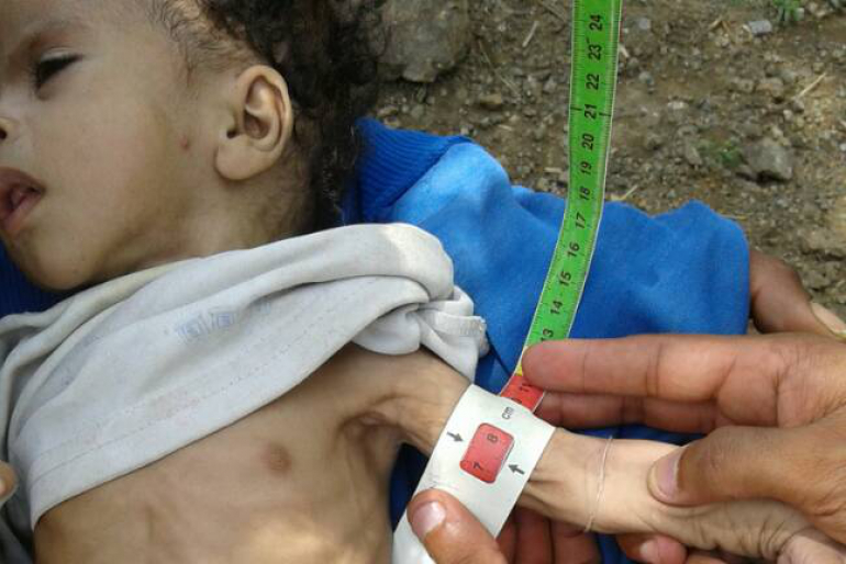 Durch verunreinigtes Wasser und schlechte hygienische Verhältnisse sind viele Jemeniten an der tödlichen Cholera erkrankt. Mangelernährte Kinder sind besonders gefährdet.