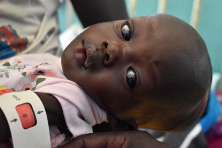 Das MUAC-Band zeigt bei Malang einen Oberarmumfang von nur acht Zentimetern – ein Wert im roten Bereich. 13 Zentimeter wären gesund für ein einjähriges Kind.