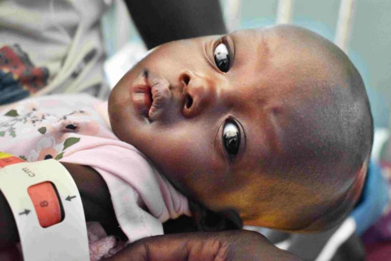 Im Südsudan herrscht eine der weltweit schlimmsten Hungerkatastrophen. Das MUAC-Band zeigt bei diesem Kind einen Oberarmumfang von nur acht Zentimetern – ein Wert im roten Bereich. 13 Zentimeter wären gesund für ein einjähriges Kind.