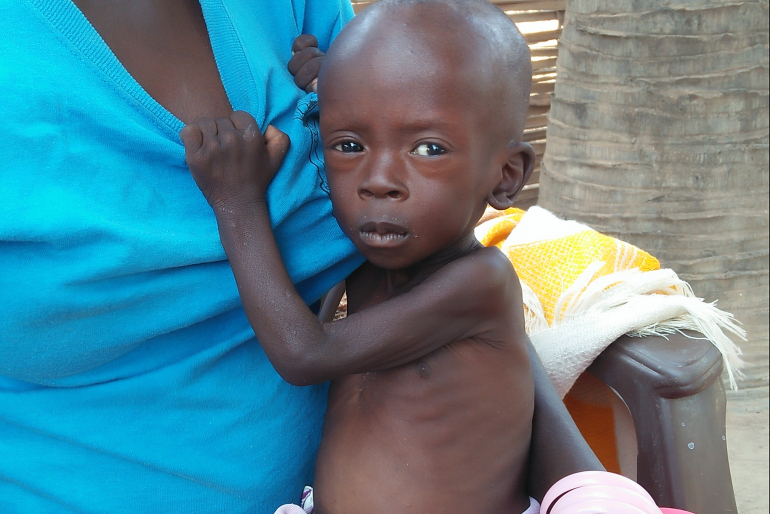 Das Ausmaß seiner Mangelernährung zeigt sich an seinem aufgeblähten Bauch, dem zu geringen Körpergewicht und der faltigen, schlaffen Haut.