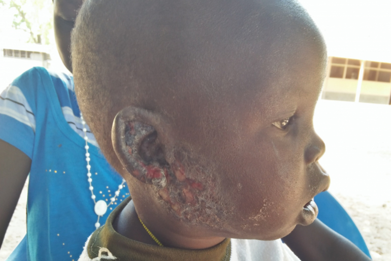 Der kleine Manhiak Monykuk (2) leidet unter einer Infektion der Haut, die für ihn sehr schmerzhaft ist. Der Junge wurde von seiner Mutter verlassen und lebt bei seiner Großmutter.