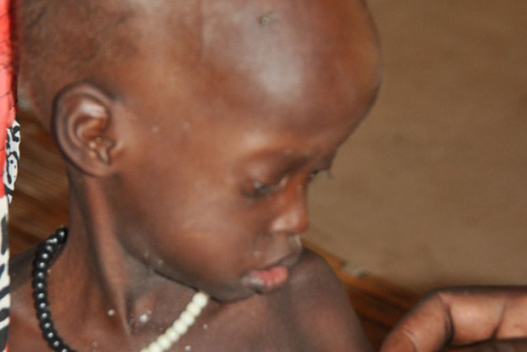 Die zweijährige Nyabuor ist schwer mangelernährt: Das MUAC-Band zeigt beim Messen des Oberarmumfangs den Wert von 9,2 cm im roten Bereich an.
