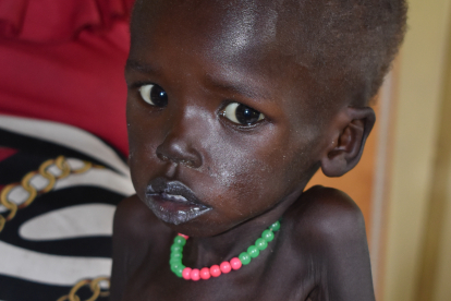 Makol Mading ist mit seinen Kräften am Ende. Der Zweijährige leidet neben Malaria und Durchfall an einer lebensbedrohlichen Mangelernährung.