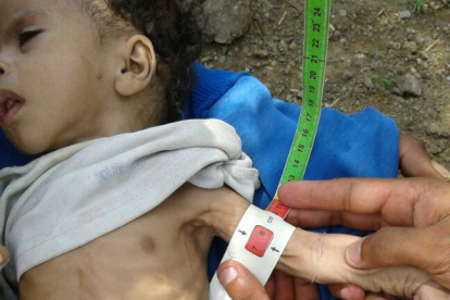 Durch verunreinigtes Wasser und schlechte hygienische Verhältnisse sind viele Jemeniten an der tödlichen Cholera erkrankt. Mangelernährte Kinder sind besonders gefährdet. Durch verunreinigtes Wasser und schlechte hygienische Verhältnisse sind viele Jemeniten an der tödlichen Cholera erkrankt. Mangelernährte Kinder sind besonders gefährdet.