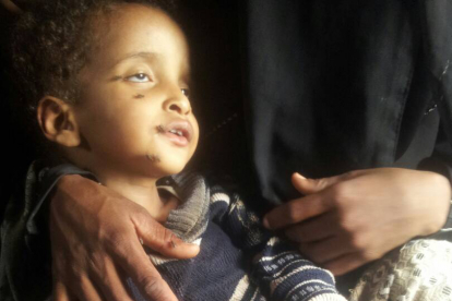 Kleinkinder sind im Jemen besonders geschwächt. Hoffnungszeichen sorgt dafür, dass unterernährte und kraftlose Kinder wie dieser Junge Spezialnahrung erhalten.
