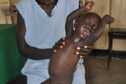 Mabeny Gai ist sieben Monate alt und schwer mangelernährt. Außerdem hat er eine Augenkrankheit, die behandelt werden muss.