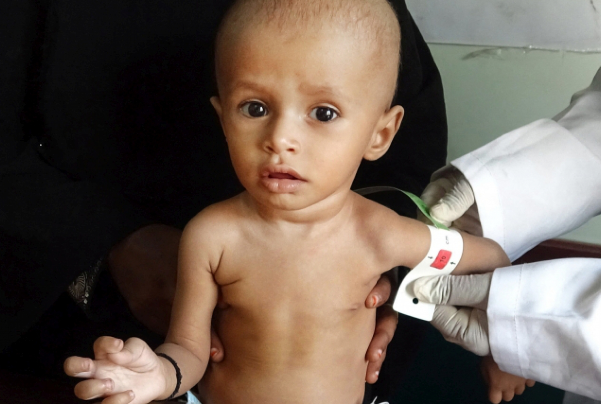 Hungerkrise im Jemen trifft die Kleinsten